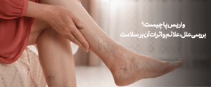 مجله سافیرامد 9 واریس پا چیست؟ بررسی علل، علائم + درمان- سافیرامد